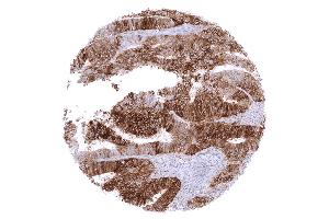 Colon Colorectal adenocarcinoma with moderate to strong membranous PD L1 staining in the vast majority of its tumor cells