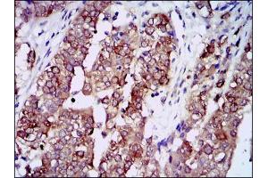 Immunohistochemical analysis of paraffin-embedded bladder cancer tissues using HSP90AA1 mouse mAb with DAB staining.