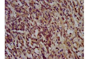 IHC image of ABIN7169549 diluted at 1:200 and staining in paraffin-embedded human gastric cancer performed on a Leica BondTM system.