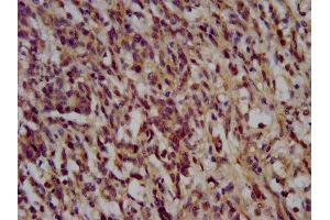 IHC image of ABIN7169549 diluted at 1:200 and staining in paraffin-embedded human gastric cancer performed on a Leica BondTM system. (NANS anticorps  (AA 132-259))