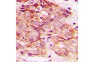 Immunohistochemical analysis of ERGIC3 staining in human breast cancer formalin fixed paraffin embedded tissue section.