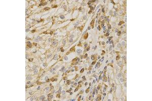 Immunohistochemistry of paraffin-embedded human kidney cancer using Bak1 antibody at dilution of 1:200 (x400 lens).
