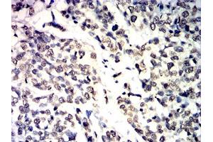 Immunohistochemical analysis of paraffin-embedded bladder cancer tissues using IL1B mouse mAb with DAB staining.