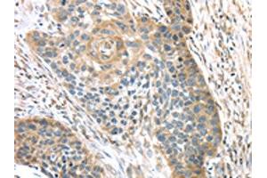 The image on the left is immunohistochemistry of paraffin-embedded Human esophagus cancer tissue using ABIN7131395(TMPRSS11A Antibody) at dilution 1/30, on the right is treated with fusion protein. (TMPRSS11A anticorps)