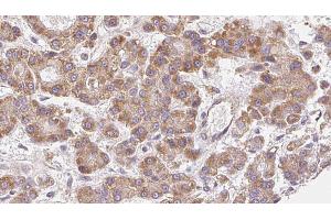 ABIN6272490 at 1/100 staining Human liver cancer tissue by IHC-P. (CACNA1G anticorps  (N-Term))