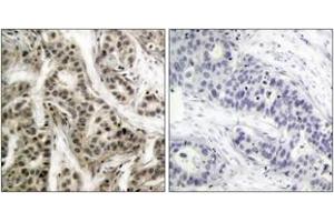 Immunohistochemistry analysis of paraffin-embedded human breast carcinoma, using NF-kappaB p105/p50 (Phospho-Ser337) Antibody. (NFKB1 anticorps  (pSer337))