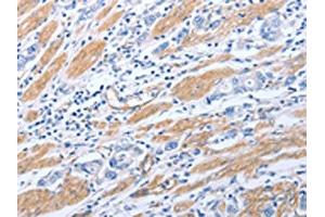 The image on the left is immunohistochemistry of paraffin-embedded Human gastric cancer tissue using ABIN7190790(GFRA4 Antibody) at dilution 1/40, on the right is treated with synthetic peptide.