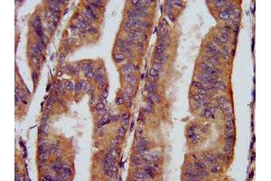 IHC image of ABIN7161356 diluted at 1:400 and staining in paraffin-embedded human endometrial cancer performed on a Leica BondTM system.