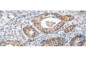 Immunohistochemistry of paraffin-embedded Human cervical cancer tissue using ZPBP Polyclonal Antibody at dilution of 1:30(x200)