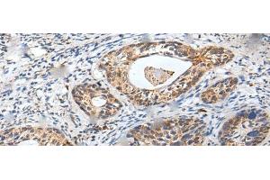 Immunohistochemistry of paraffin-embedded Human cervical cancer tissue using ZPBP Polyclonal Antibody at dilution of 1:30(x200) (ZPBP anticorps)