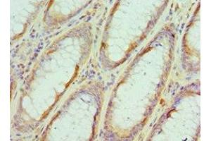 Immunohistochemistry of paraffin-embedded human colon cancer using ABIN7152105 at dilution of 1:100 (EIF4A1 anticorps  (AA 167-406))
