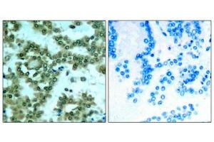 Immunohistochemical analysis of paraffin-embedded human lung carcinoma tissue using PKCth(Phospho-Ser676) Antibody(left) or the same antibody preincubated with blocking peptide(right).