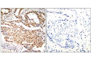 Immunohistochemical analysis of paraffin-embedded human breast carcinoma tissue using MEF2A (Phospho-Ser408) antibody (E011309). (MEF2A anticorps  (pSer408))