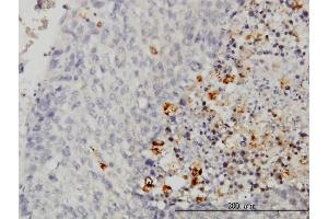 Immunoperoxidase of monoclonal antibody to CASP1 on formalin-fixed paraffin-embedded human hepatocellular carcinoma.