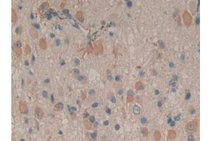 Detection of CYP-40 in Human Glioma Tissue using Polyclonal Antibody to Cyclophilin 40 (CYP-40)