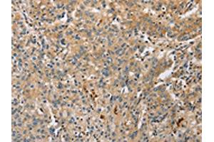 The image on the left is immunohistochemistry of paraffin-embedded Human gastric cancer tissue using ABIN7128517(ARL8A Antibody) at dilution 1/20, on the right is treated with fusion protein. (ARL8A anticorps)