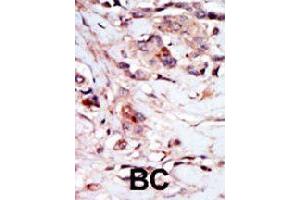 Formalin-fixed and paraffin-embedded human cancer tissue reacted with NPR1 polyclonal antibody  , which was peroxidase-conjugated to the secondary antibody, followed by AEC staining. (NPR1 anticorps  (N-Term))
