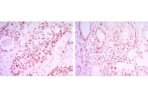 Immunohistochemical analysis of paraffin-embedded lung cancer tissues (left) and kidney cancer tissues (right) using SIRT1 mouse mAb with DAB staining. (SIRT1 anticorps)