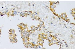 Immunohistochemistry of paraffin-embedded Human lung cancer using ART1 Polyclonal Antibody at dilution of 1:100 (40x lens). (ART1 anticorps)