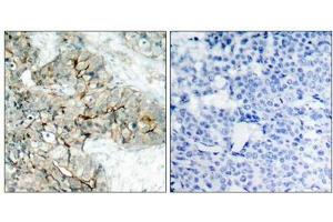 Immunohistochemical analysis of paraffin-embedded human breast carcinoma tissue using Integrin b3(Phospho-Tyr773) Antibody(left) or the same antibody preincubated with blocking peptide(right). (Integrin beta 3 anticorps  (pTyr773))