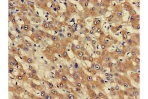 Immunohistochemistry of paraffin-embedded human liver cancer using ABIN7163052 at dilution of 1:100