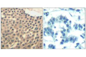 Immunohistochemical analysis of paraffin-embedded human lung carcinoma tissue using HDAC4/HDAC5/HDAC9(Ab-246/259/220) Antibody(left) or the same antibody preincubated with blocking peptide(right). (HDAC4/HDAC5/HDAC9 anticorps)