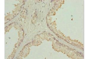 Immunohistochemistry of paraffin-embedded human prostate cancer using ABIN7169213 at dilution of 1:100 (ULK3 anticorps  (AA 44-240))