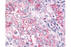 Anti-USP4 / UNP antibody IHC of human Lung, Non-Small Cell Carcinoma. (USP4 anticorps  (N-Term))