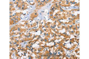Immunohistochemistry of Human thyroid cancer using CXCL14 Polyclonal Antibody at dilution of 1:40 (CXCL14 anticorps)