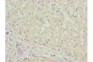 Immunohistochemistry of paraffin-embedded human liver tissue using ABIN7169532 at dilution of 1:100 (DHRS3 anticorps  (AA 30-169))