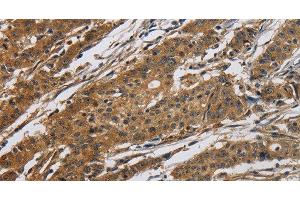 Immunohistochemistry of paraffin-embedded Human gastric cancer tissue using Claudin 2 Polyclonal Antibody at dilution 1:50 (Claudin 2 anticorps)