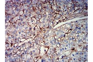 Immunohistochemical analysis of paraffin-embedded liver cancer tissues using MUC16 mouse mAb with DAB staining.