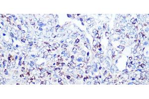 Immunohistochemistry of paraffin-embedded Human oophoroma using CD68 Polyclonal Antibody at dilution of 1:100 (40x lens). (CD68 anticorps)