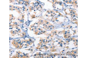 Immunohistochemistry of Human thyroid cancer using AHR Polyclonal Antibody at dilution of 1:50 (Aryl Hydrocarbon Receptor anticorps)