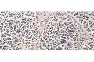 Immunohistochemistry of paraffin-embedded Human breast cancer tissue using PAIP1 Polyclonal Antibody at dilution of 1:80(x200) (PAIP1 anticorps)
