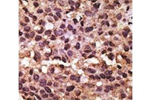 IHC analysis of FFPE human breast carcinoma tissue stained with the BNIP3 antibody (BNIP3 anticorps  (AA 152-187))