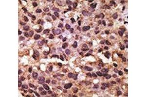 IHC analysis of FFPE human breast carcinoma tissue stained with the BNIP3 antibody
