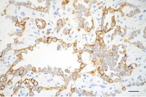 Immunohistochemistry was performed on paraffin-embedded human lung adenocarcinoma using CD8 alpha antibody (ABIN7797987), 1:200). (Recombinant CD8 alpha anticorps)
