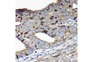 Immunohistochemistry of paraffin-embedded human colon carcinoma using PRC1 Rabbit pAb (ABIN6128502, ABIN6146124, ABIN6146125 and ABIN6222808) at dilution of 1:100 (40x lens).
