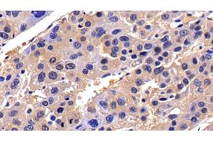 Detection of CASP8 in Human Liver cancer Tissue using Polyclonal Antibody to Caspase 8 (CASP8)
