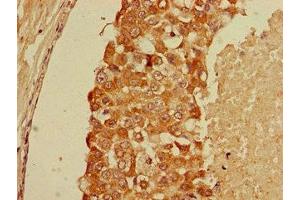 Immunohistochemistry of paraffin-embedded human breast cancer using ABIN7153717 at dilution of 1:100