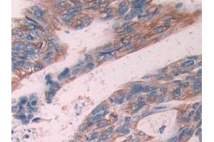 Detection of KRT6C in Human Colorectal cancer Tissue using Polyclonal Antibody to Keratin 6C (KRT6C)