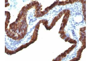 Formalin-fixed, paraffin-embedded human Ovarian Carcinoma stained with Cytokeratin 7 Monoclonal Antibody (KRT7/760 + OV-TL12/30) (Cytokeratin 7 anticorps)