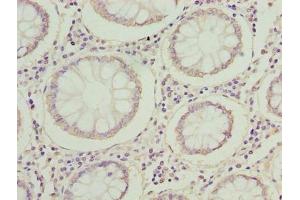 Immunohistochemistry of paraffin-embedded human colon cancer using ABIN7142353 at dilution of 1:100 (MRPL14 anticorps  (AA 1-145))