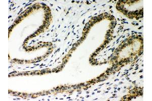 Anti- ATP5H Picoband antibody,IHC(P) IHC(P): Human Mammary Cancer Tissue