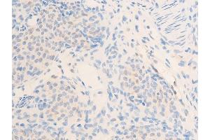 ABIN6267284 at 1/100 staining rat ovarian cancer tissue sections by IHC-P.