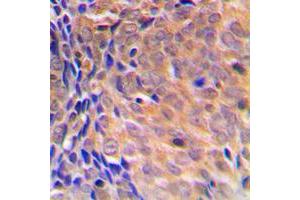Immunohistochemical analysis of COPS3 staining in human breast cancer formalin fixed paraffin embedded tissue section.