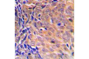Immunohistochemical analysis of COPS3 staining in human breast cancer formalin fixed paraffin embedded tissue section.