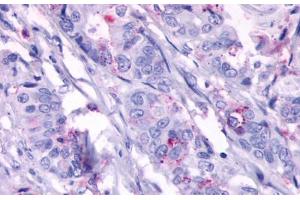 Anti-GPR124 antibody  ABIN1048704 IHC staining of human colon carcinoma, neoplastic cells. (GPR124 anticorps  (N-Term))