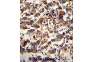 TFAM antibody immunohistochemistry analysis in formalin fixed and paraffin embedded human testis carcinoma followed by peroxidase conjugation of the secondary antibody and DAB staining. (TFAM anticorps  (C-Term))